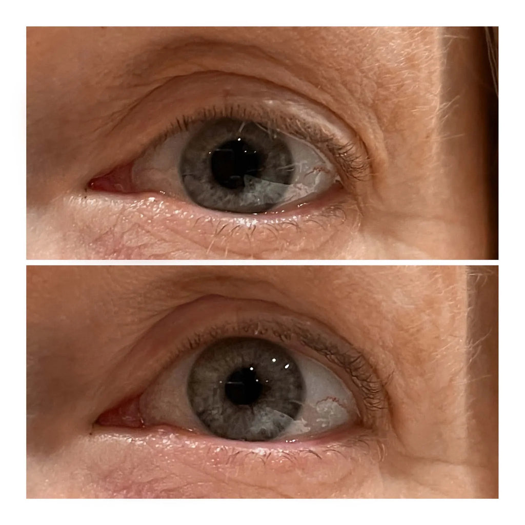 VARITA LIFTING DE OJOS