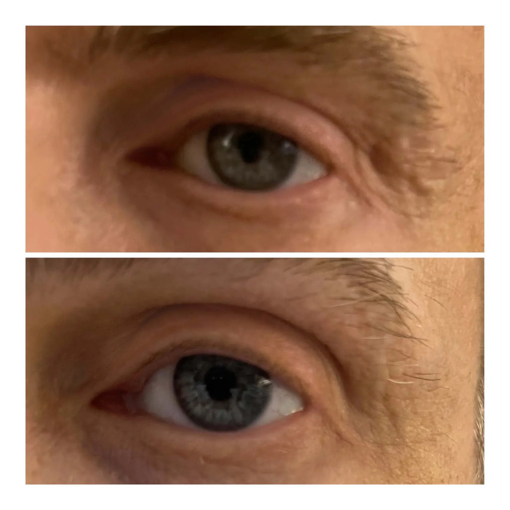 VARITA LIFTING DE OJOS