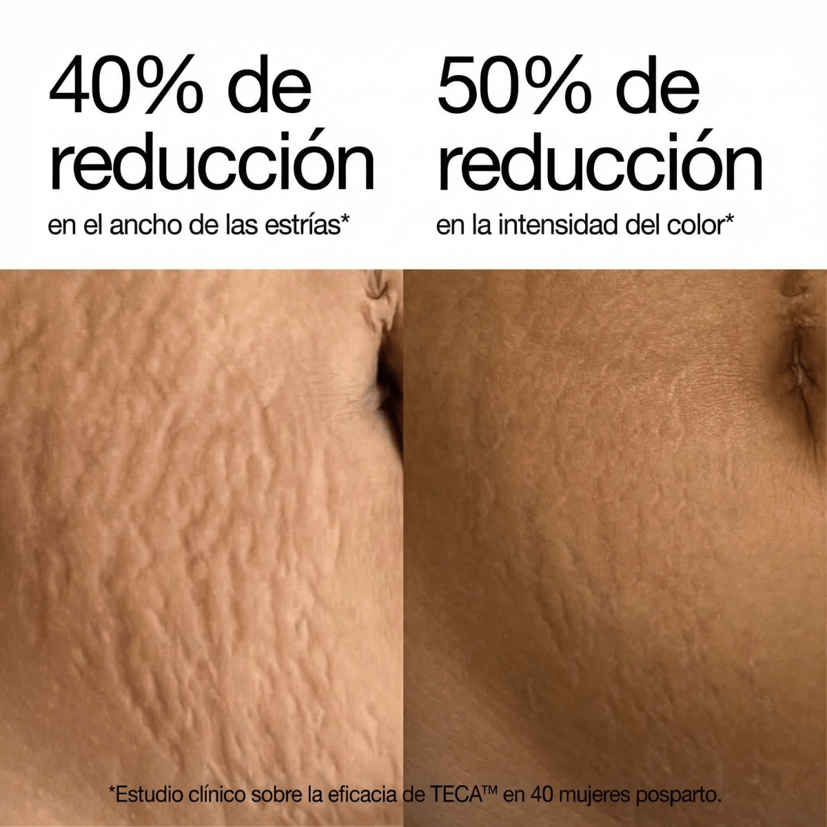 Redefiniendo la crema para estrías